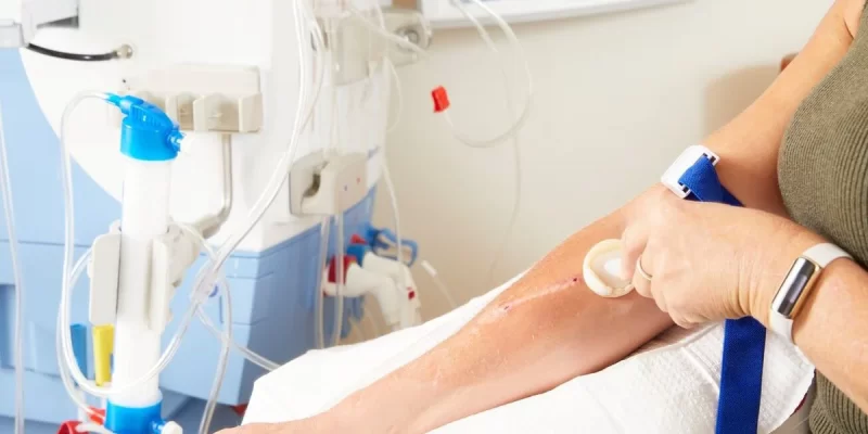 AV Fistula Surgery for Dialysis