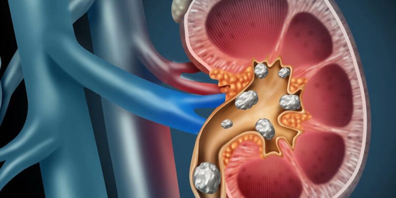 Kidney Stone Removal